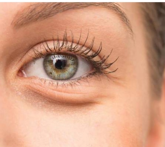 تیرگی و چروک دور چشم